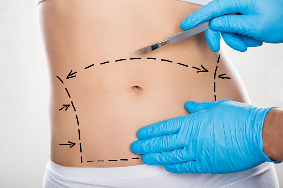 Abdominoplastik Ratingen