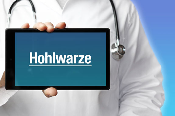 Schlupfwarzen Ratingen